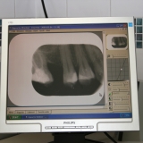 Digitális röntgen